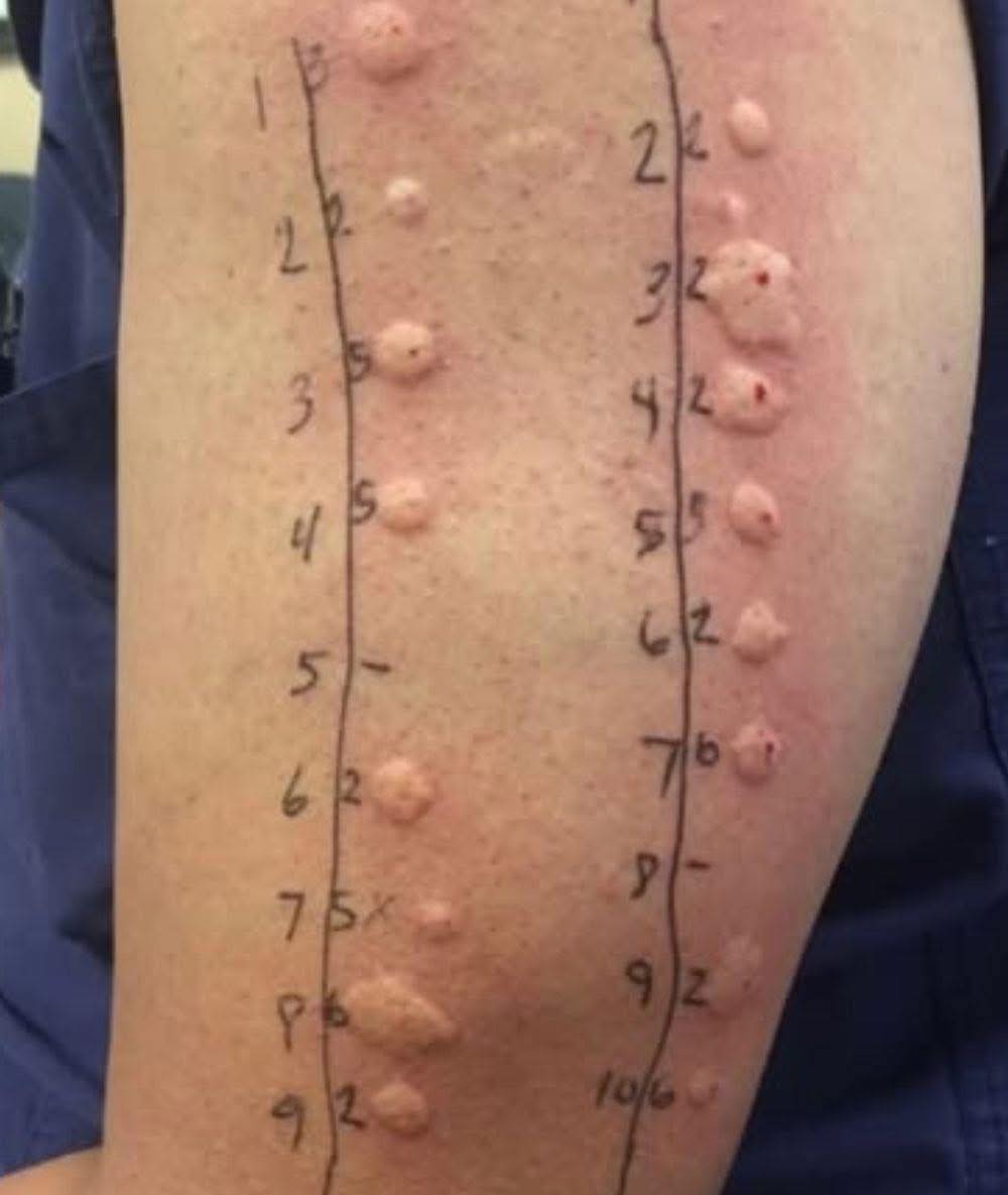 Hai notato questo sulla pelle al risveglio? Ecco cosa potrebbe essere e quando preoccuparsi