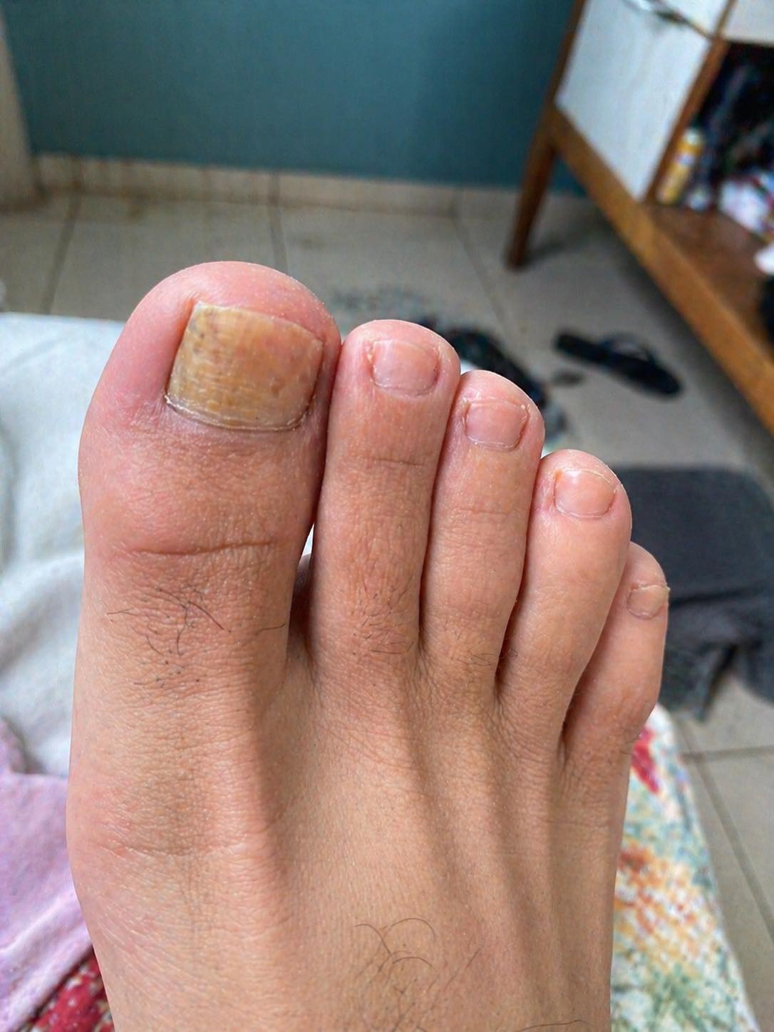 Di' addio ai funghi alle unghie con questo semplice rimedio naturale