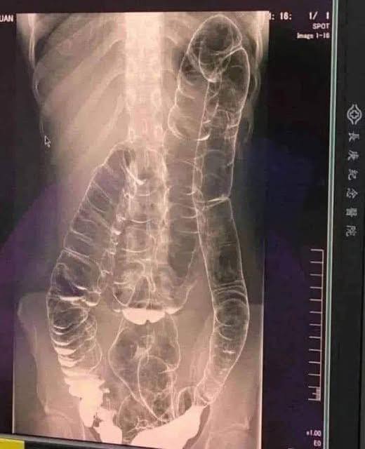 Colon intasato: quando il corpo lancia segnali d'allarme