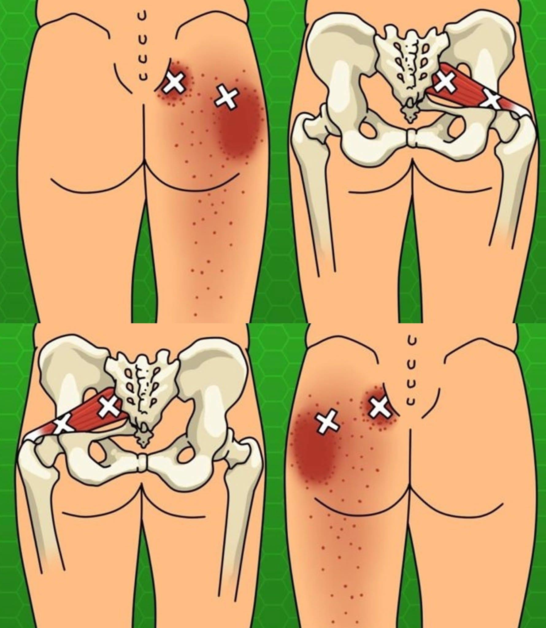 Conosci queste soluzioni naturali per alleviare la sciatica e il mal di schiena?