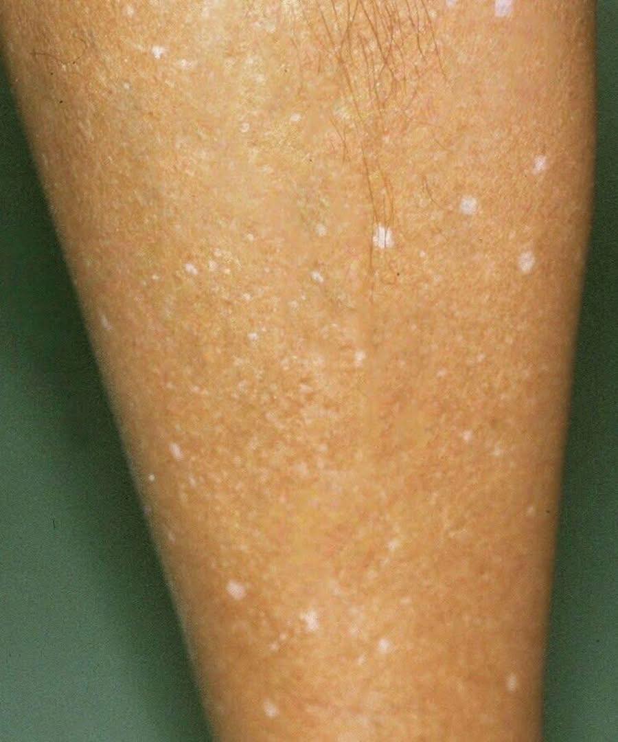 Cosa si nasconde dietro le macchie bianche sulla pelle? Ecco le possibili cause
