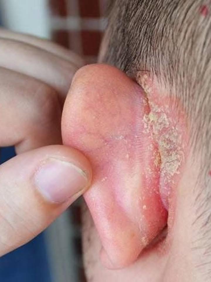 Macchia sull'orecchio del bambino: cosa può essere e come prendersi cura fino alla visita medica?