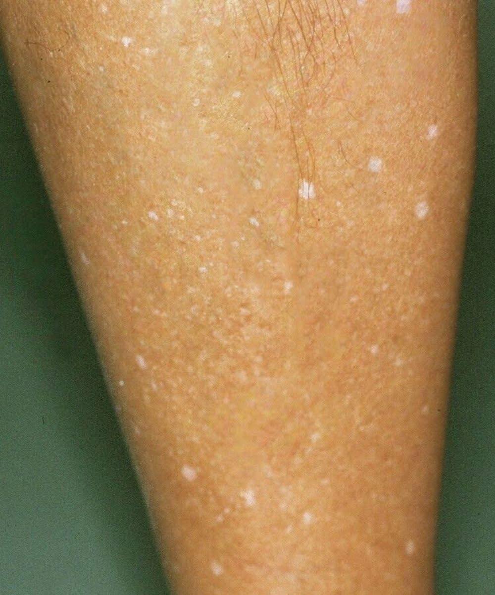 Cosa si nasconde dietro le macchie bianche sulla pelle? Ecco le possibili cause
