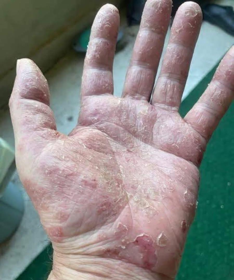 Se ti compare questo sulle mani, fai attenzione! Scopri perché non puoi ignorare questi segnali